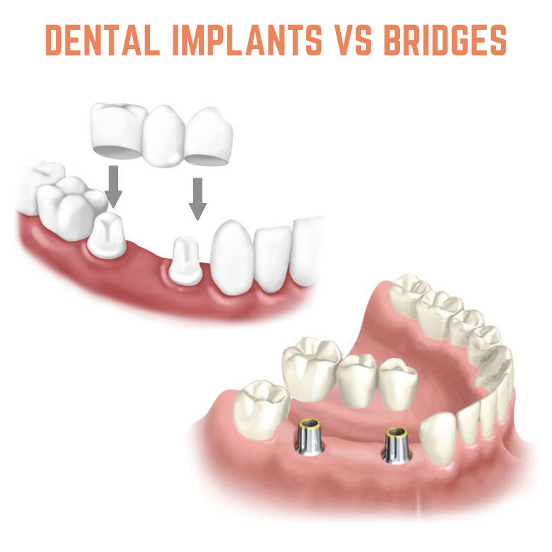 dental implants