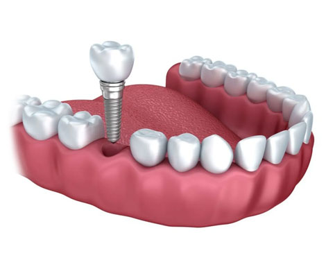 Single and Multiple Dental Implants