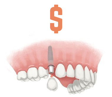 dental implant costs