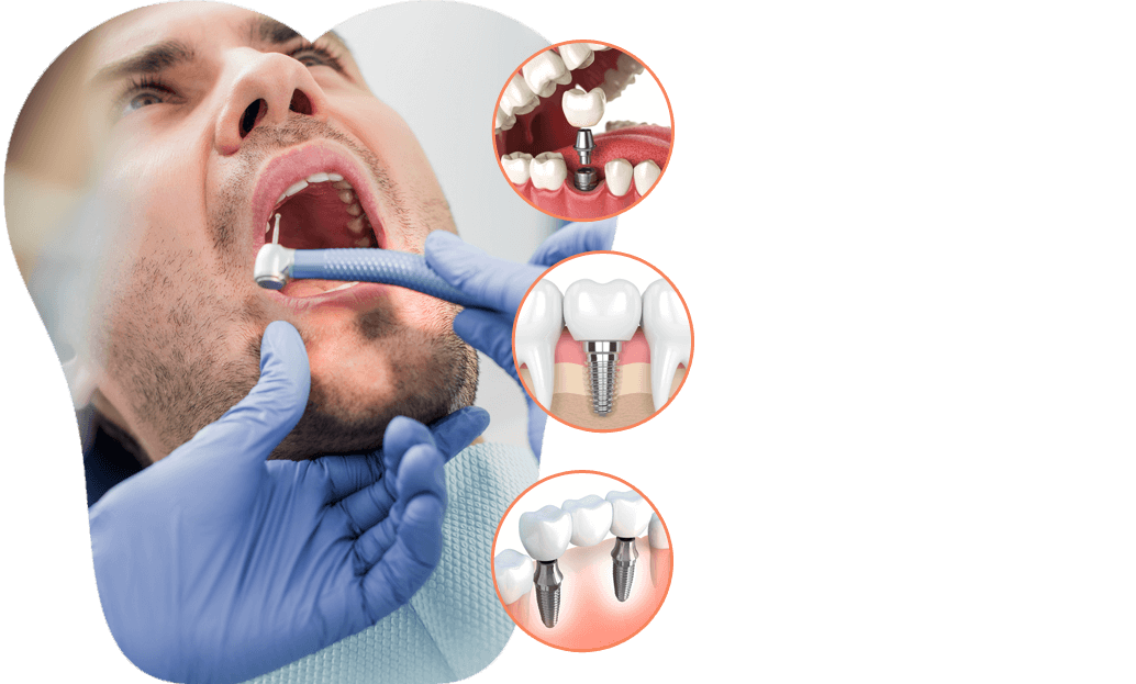 dental-implant-solution