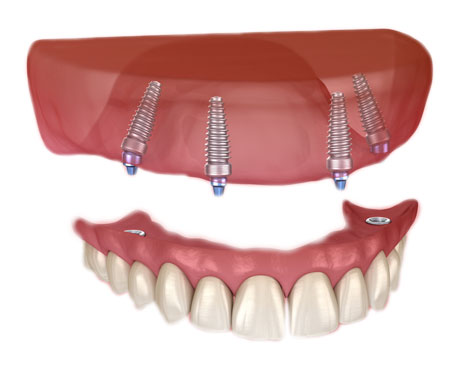 Single and Multiple Dental Implants